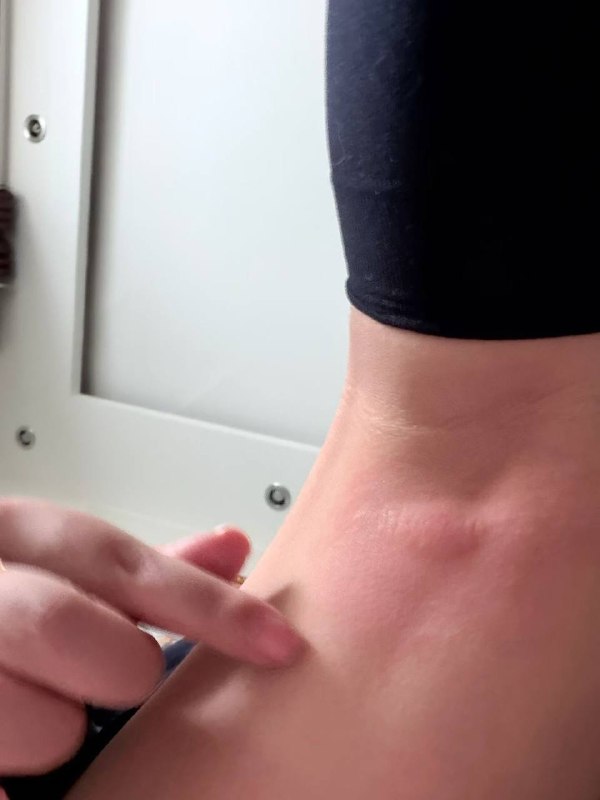这蚊子真是无敌了这蚊子真是无敌了