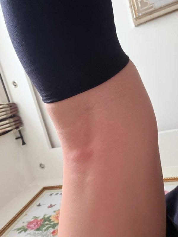 这蚊子真是无敌了这蚊子真是无敌了