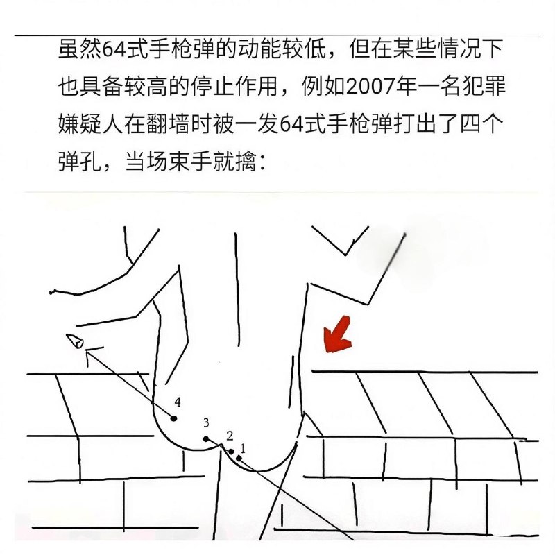 后来医生缝了五个